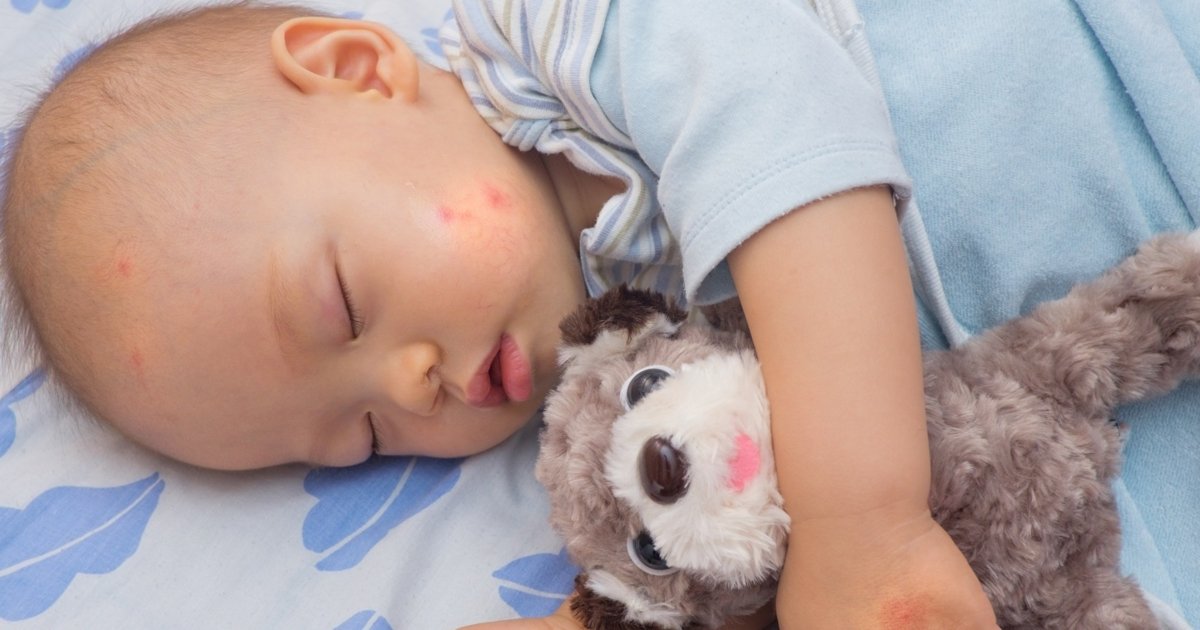 Allergy to mosquito bites in children