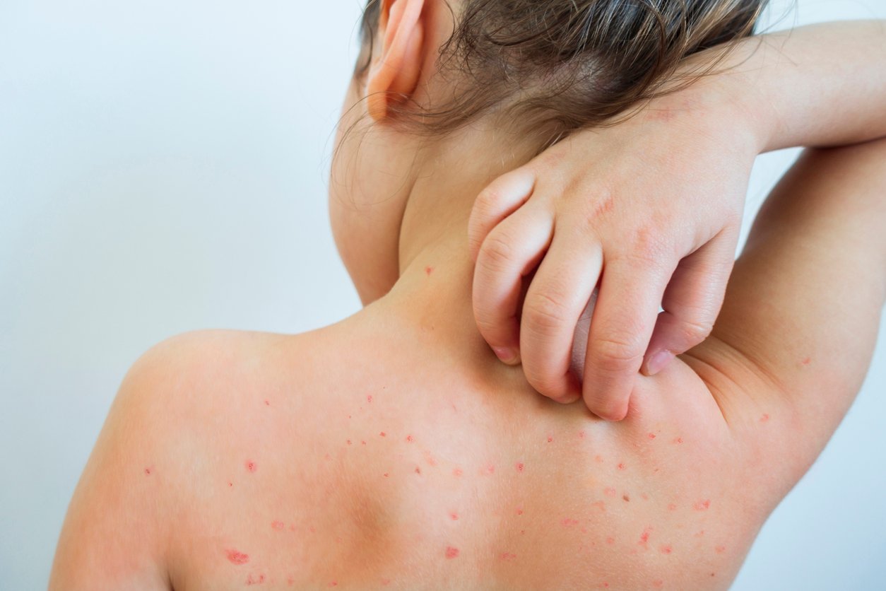 Contact dermatitis in children. Symptoms. Treatment