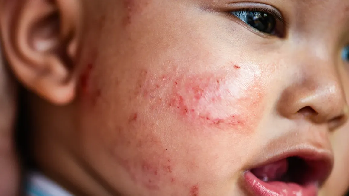 Eczema in children