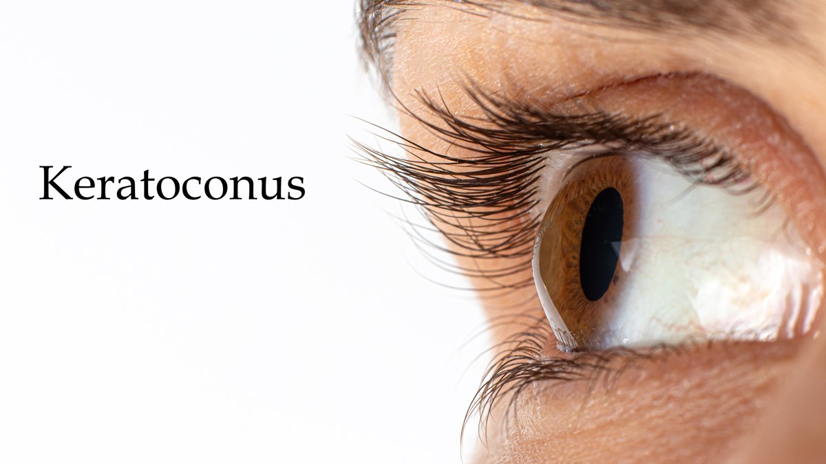 Keratoconus. What kind of disease is this? How is it treated?