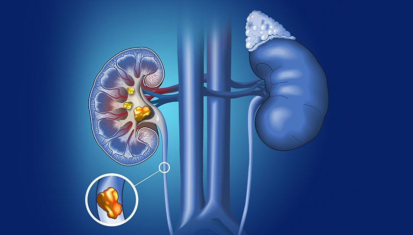 Quantitative urine disorders. Symptoms. Treatment