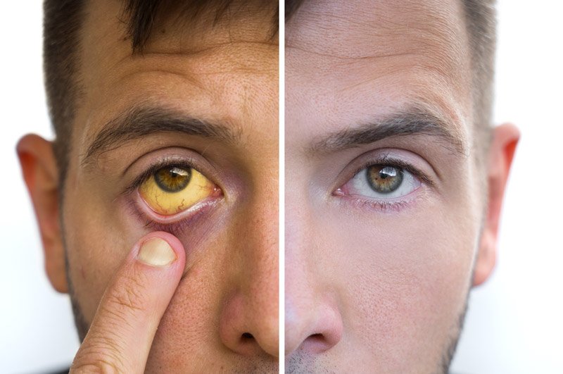 What Causes Yellow Eyes